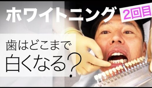 【効果的】オフィスホワイトニング２回目｜歯を確実に白く＆キープするおすすめのやり方【これはスゴイ…】