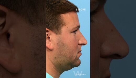 Remove your double chin and contour your lower face with CoolSculpting and Ultherapy