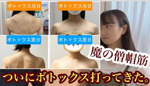 【ぶ厚い肩】魔の僧帽筋、ついに肩ボトックスを打ってきた。【ボトックス】【僧帽筋】