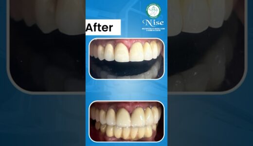 #smilemakeover #how #smile #crowns #ceramic