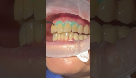 Blanqueamiento dental ANTES Y DESPUÉS 💥🦷 | Clínica Dental ClearDent #shortviral