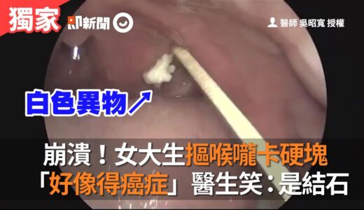 崩潰！女大生摳喉嚨卡硬塊「好像得癌症」醫生笑：是結石