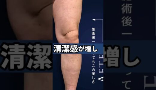 メンズ脱毛はマナーの時代！ニオイやムレも防ぎます！#shorts #メンズ脱毛 #メンズ美容 #vio脱毛