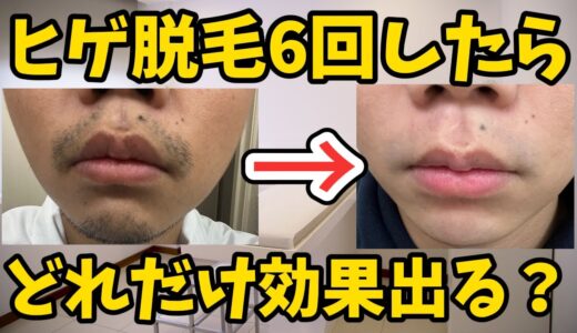 【ヒゲ医療脱毛】6回したらどれだけ効果出る？？【1週間写真撮って比較してみた】