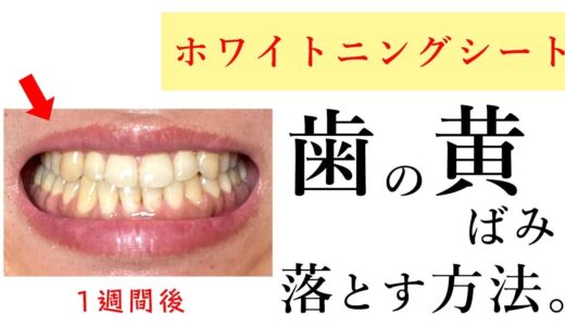 自宅で簡単に歯の黄ばみを落とす方法！【ホワイトニングシートの使い方】