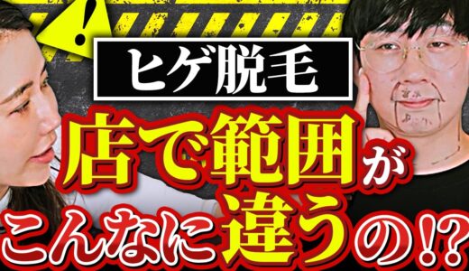 【9割の人が知らない】クリニックによって違う！ヒゲ脱毛の範囲の真実を暴露！