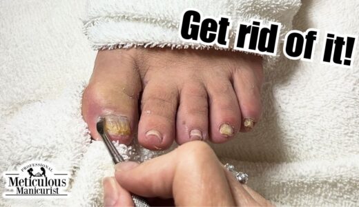 How to Get Rid of Yellow Toenails #nails #satisfying