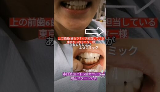 全国前歯の今井です💎　上の前歯６歯をセラミック担当している東京からのモニター様✴️本日は下の前歯６歯の施術スタートです。上が美しくなり下が目立ってしまっていました。#セラミック#セラミック矯正