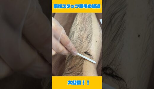 【医療脱毛】脱毛の経過大公開！【メンズ美容】