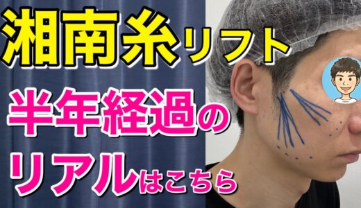 【金ドブ？】40代が糸14本入れて半年経ったらこうなりました【糸リフト】