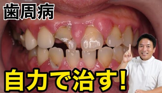 歯周病を治すならここを磨け！！