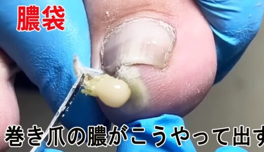 爪の先が腫れて痛い、化膿性爪囲炎がして、巻き爪の膿がこうやって出します。足もよくなります、＃巻き爪＃フットケア＃治療