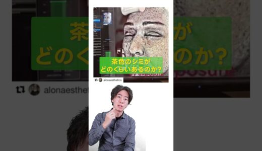 【最新肌診断機】肌診断VISIAを使ったら放置したらマズい○○があった。。 #美容 #肌診断 #ニキビ #シワ