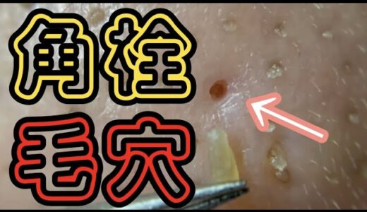 【スッキリ】久しぶりの角栓収穫！part9 Blackheads