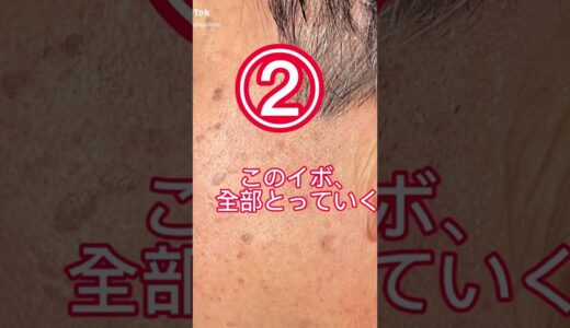 顔中のホクロ、シミとっただけで清潔感爆上がり😊BRIGHTS beauty clinic今村直樹