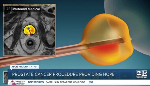 A new treatment option for men battling prostate cancer