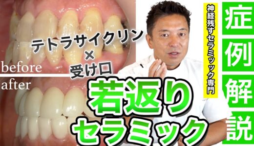 【若返りセラミック】受け口×黒い歯（テトラサイクリン）を治療した若返り症例解説！