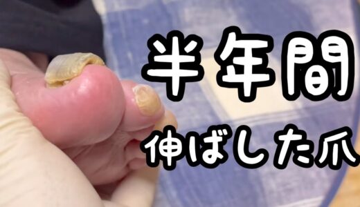 【創傷ケア】半年間伸ばしたままの爪のフットケア