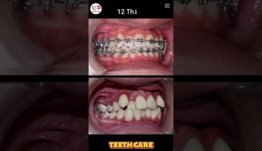 24 months transformation #teeth #braces #dental #dentalcare #dentalhealth #dentalimplants