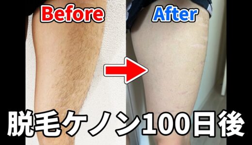 脱毛器ケノンを100日使ってみたガチレビュー #脱毛 #ケノン #家庭用脱毛器