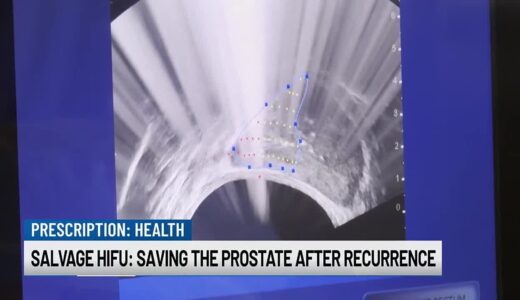 Salvage HIFU: Saving the prostate after recurrence