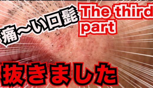 趣味脱毛250117口髭#3　Hair Removal