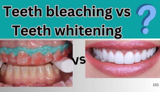 teeth bleaching vs teeth whitening  | Dr Rohan Virani