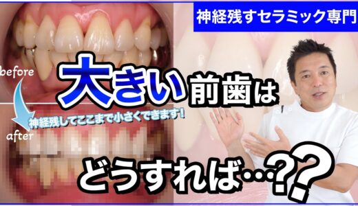 【大きな歯を小さくしたい…】 神経残すセラミックでどこまで小さくできる？！