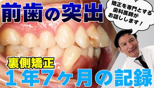 前歯の突出・デコボコの歯並びの歯列矯正の全治療過程を矯正を専門とする歯科医師が解説！【裏側矯正】【症例説明】